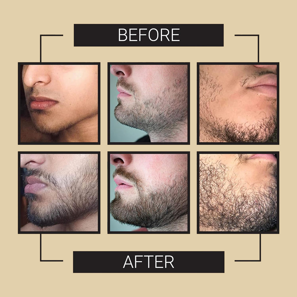 Beard Growth Kit - Grow A Thicker Fuller Beard - Beard Growth Serum - Beard Roller